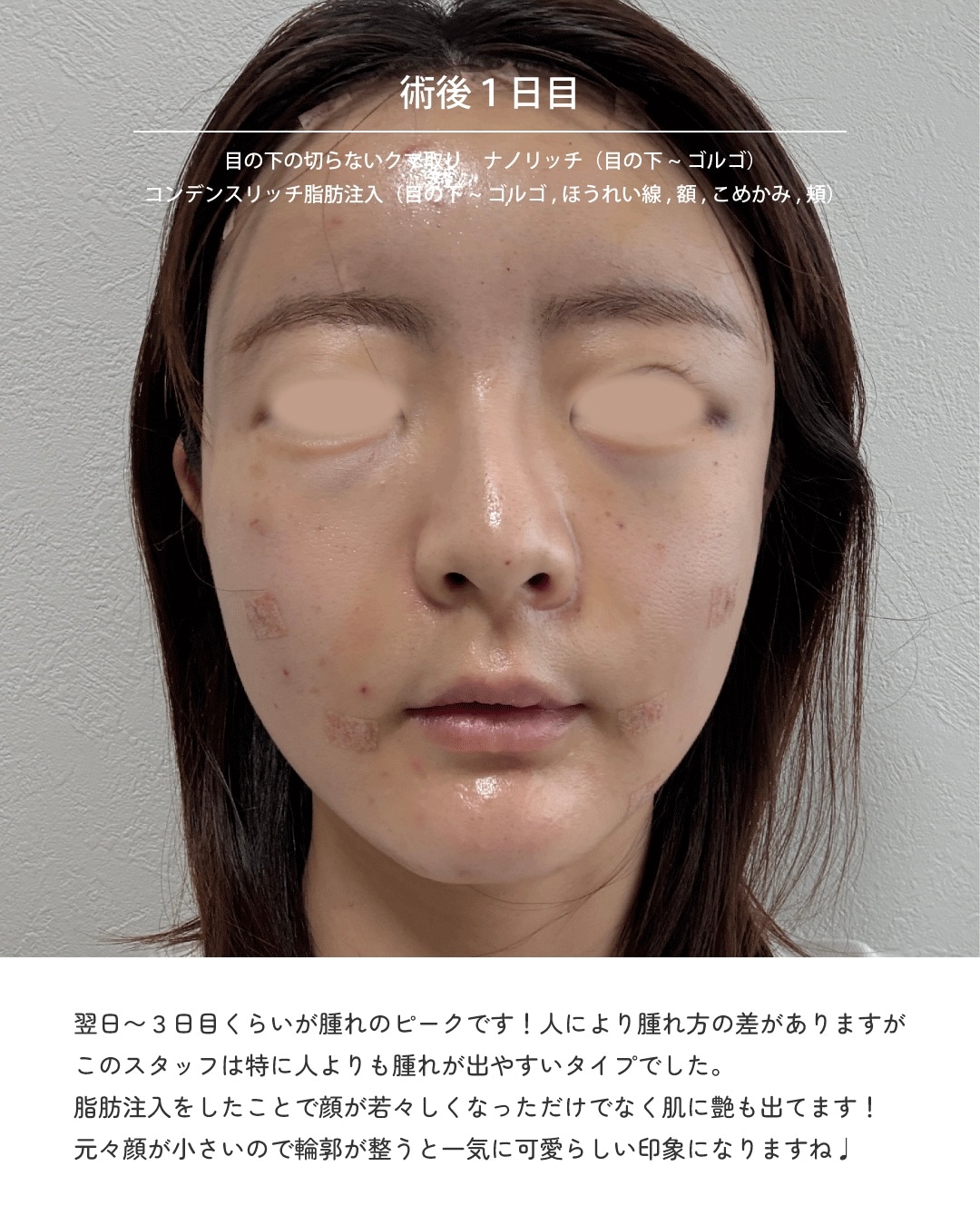 ● 術後1日目
