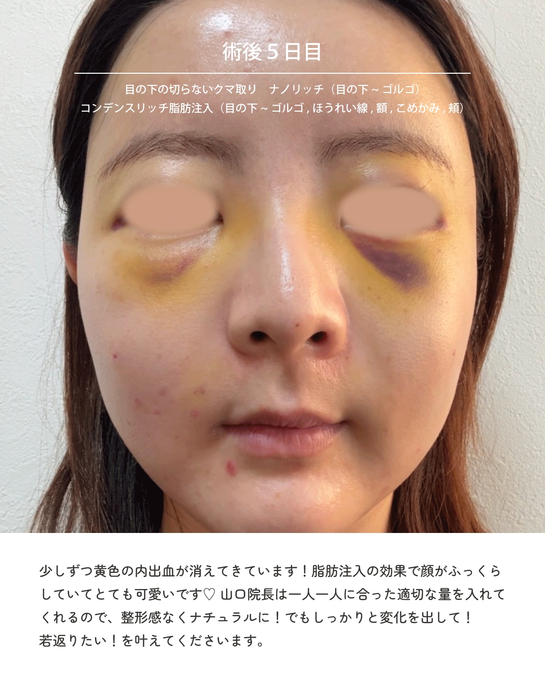 ●術後5日目