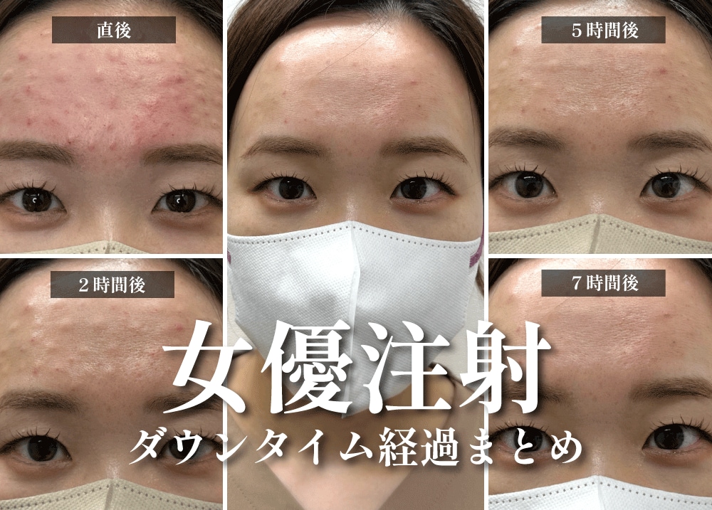 【実体験】湘南の女優注射ダウンタイム徹底レポート｜神戸・西宮北口
