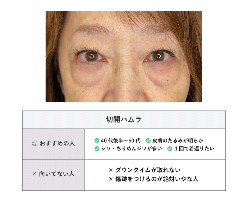 切開ハムラ法