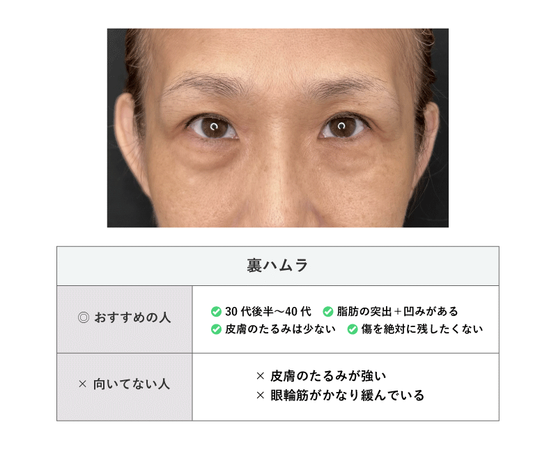 裏ハムラ法