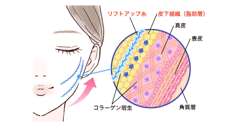④ 糸リフト｜たるみを引き上げて若返り