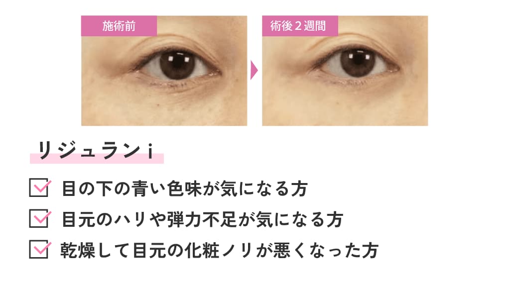 リジュランi