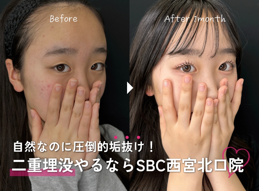 【症例多数】神戸・西宮で二重整形ならSBC西宮北口院｜自然で可愛い仕上がりの理由を徹底解説