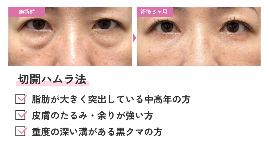 切開ハムラ