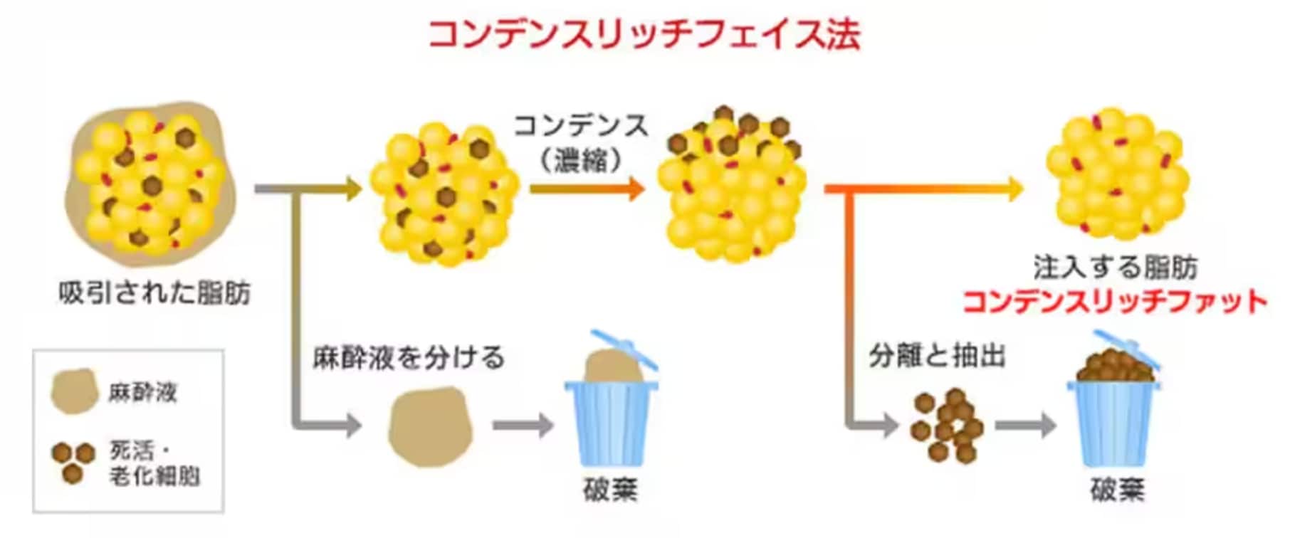 脂肪注入①コンデンスリッチフェイス法