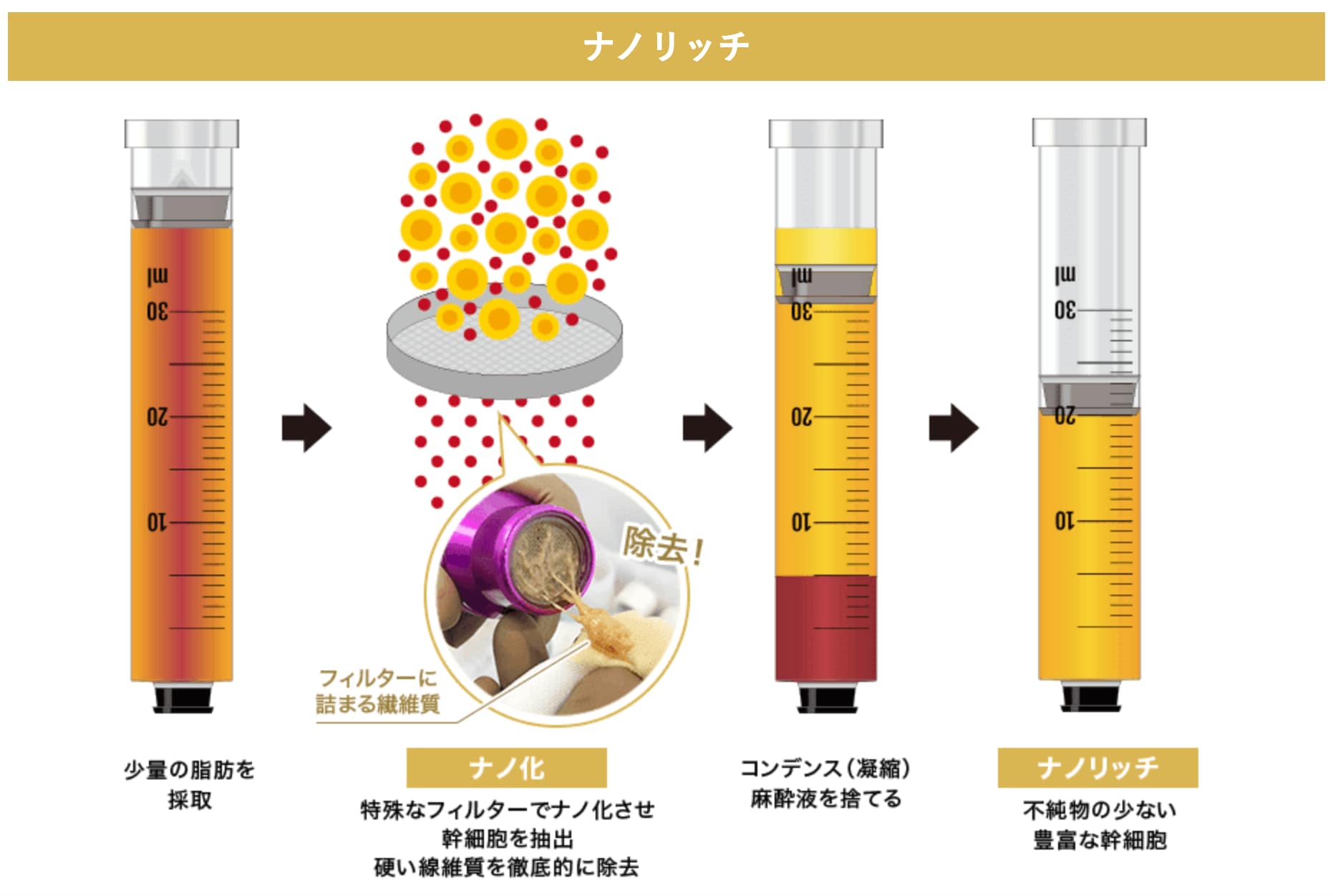 脂肪注入②ナノリッチ