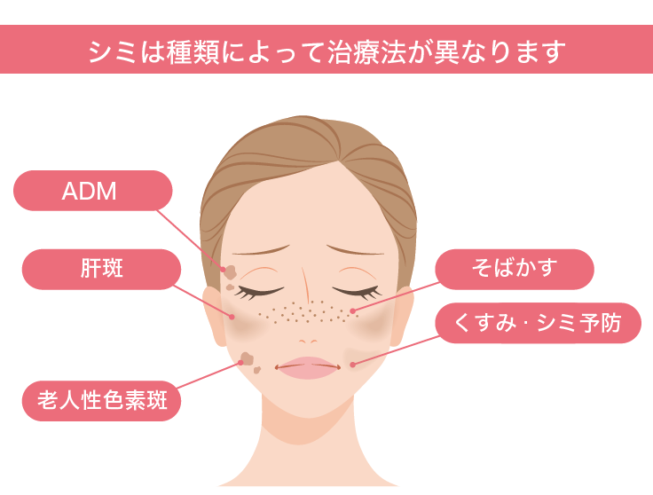 どのようなシミの種類があるの？