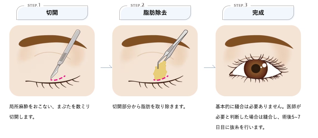 自然癒着セット（まぶたの脂肪取り）