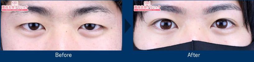 なぜ男性に二重整形が人気なのか？