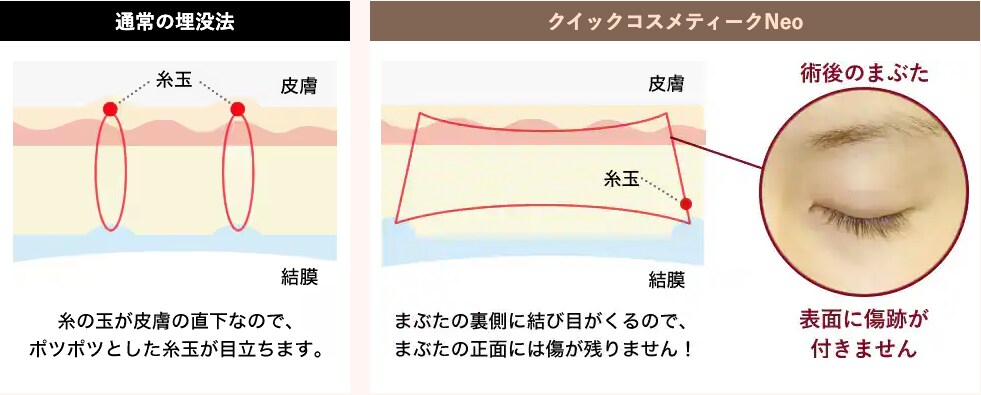 大分院の人気No1二重術【クイックコスメティーク・ダブルNeo】