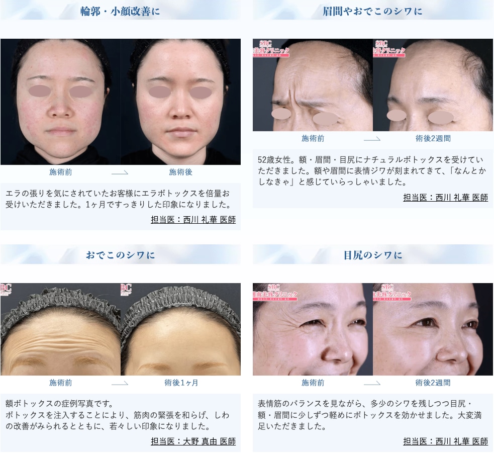 なぜ男性にボトックス注射が人気なのか？