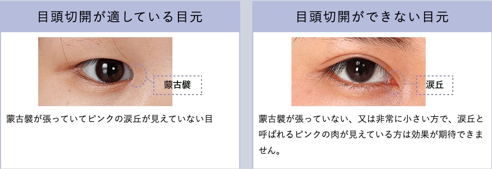 目頭切開とは？
