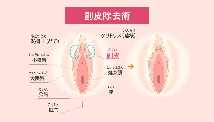 副皮除去術（抜糸あり／なし）