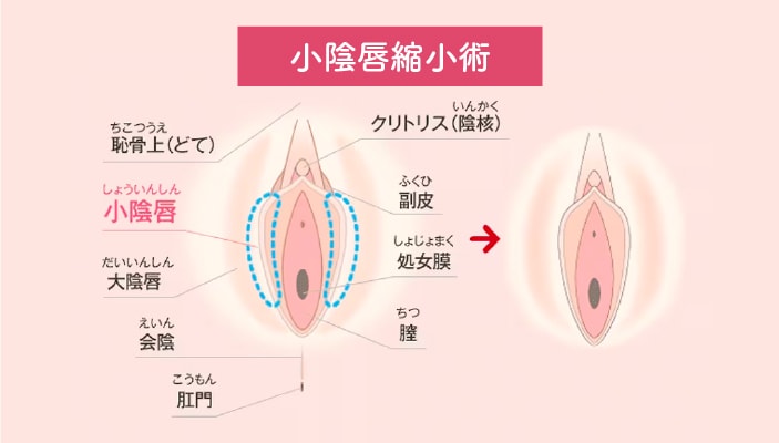 小陰唇縮小術（抜糸あり／なし）