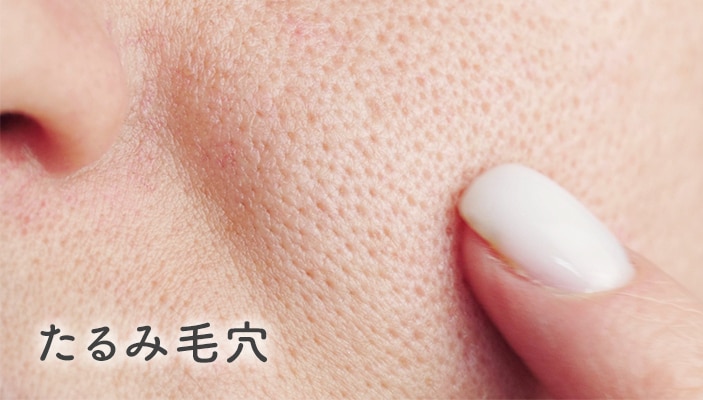 たるみ毛穴