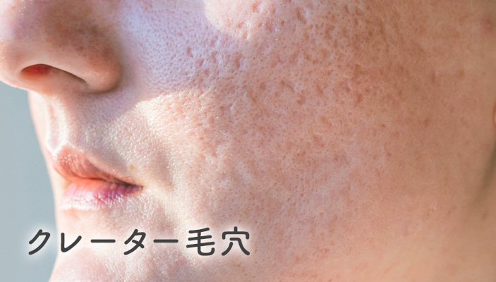 クレーター毛穴