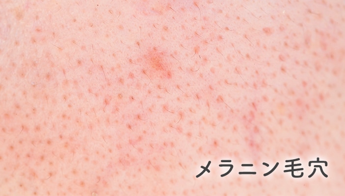 メラニン毛穴