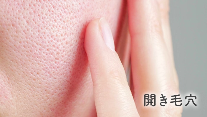 開き毛穴