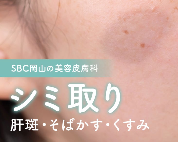 岡山でシミ取りなら湘南美容クリニック｜シミ取り放題もある！狙い撃ちから顔全体ケアまで