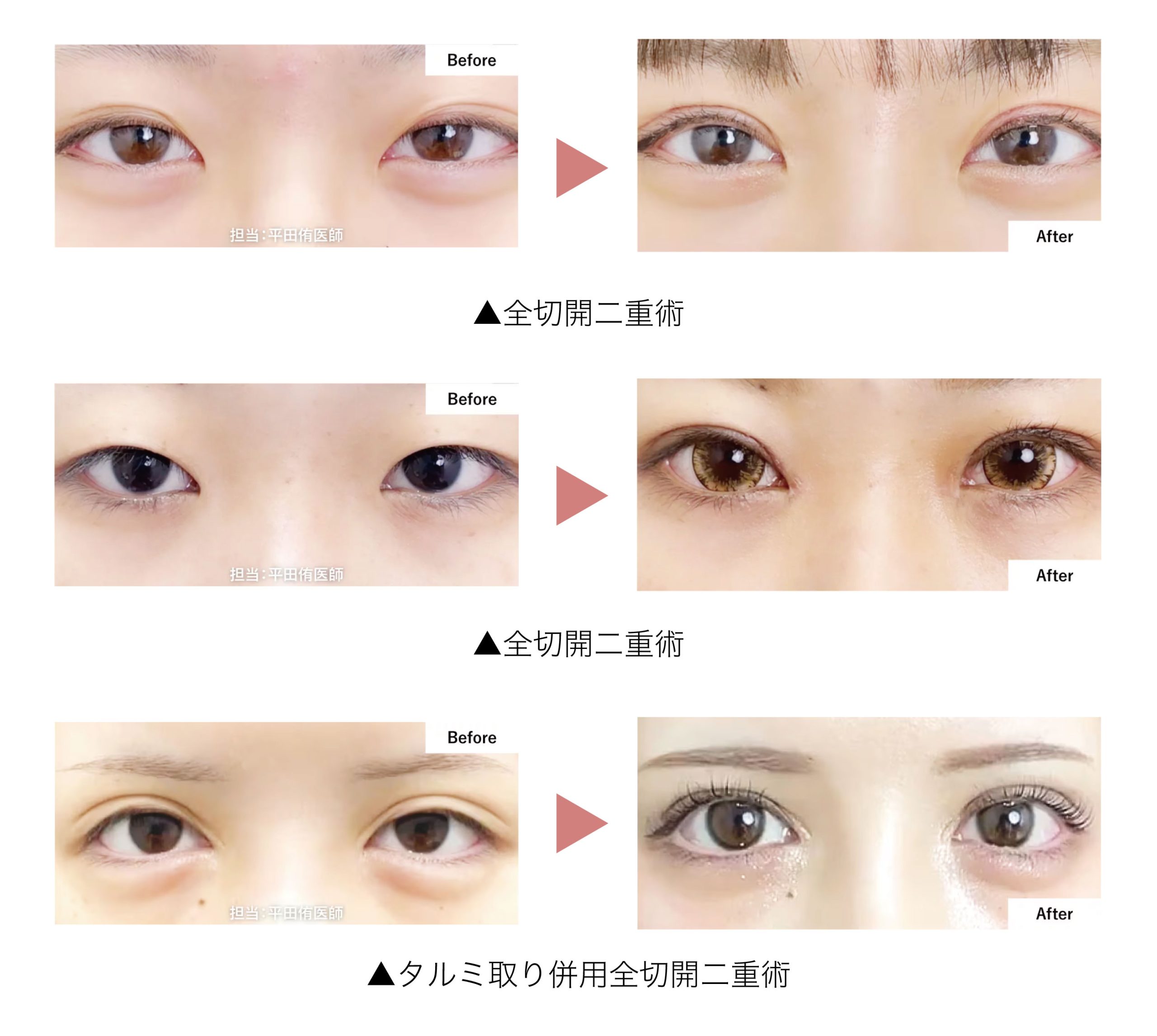 切開法