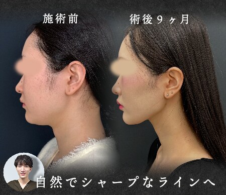 脂肪を減らすだけではない、ミリ単位の引き算が生む美しさ。