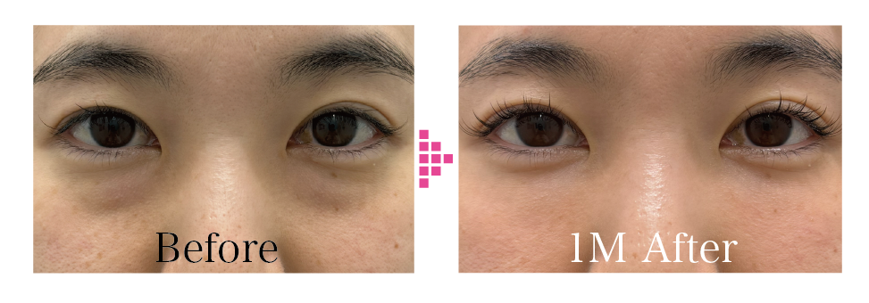 目の下の切らないたるみ取り<br />
ナチュラル脂肪注射（目の下〜ゴルゴ)<br />
