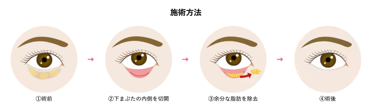 湘南美容クリニックの目の下切らないクマ・ふくらみ(たるみ)取りは<br />
身体の負担も最小限！
