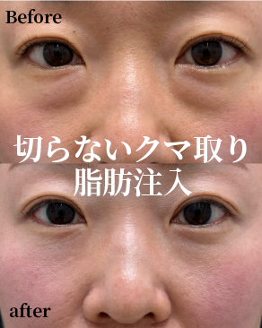切らないクマとり 全国女医症例数 No.1  2024年下半期 SBC内