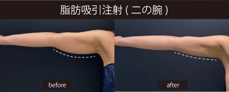 振り袖もスッキリ✨