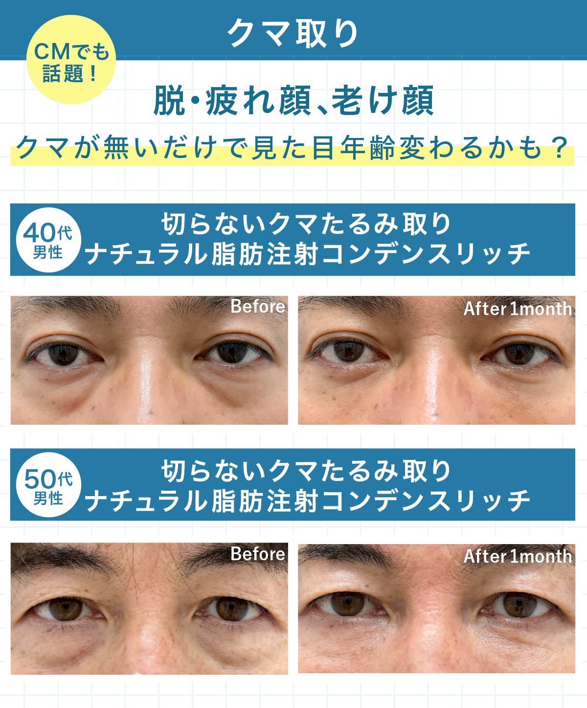 短期間で劇的変化⚡️切らないクマたるみ取り
