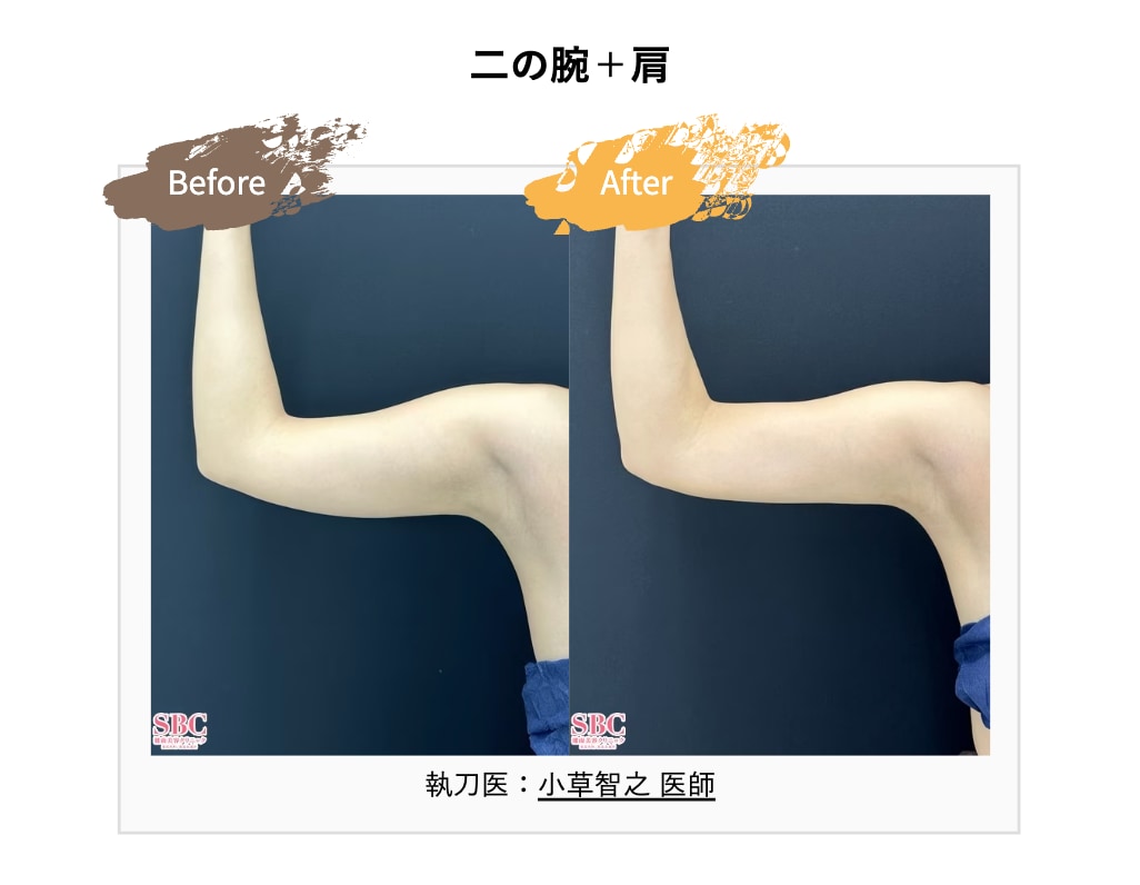 二の腕