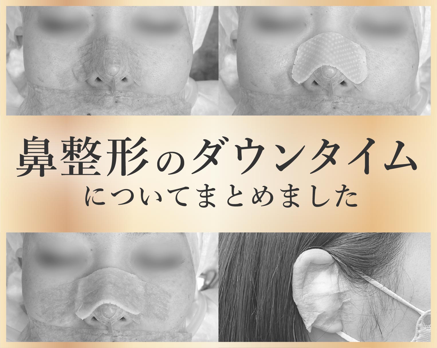 鼻整形のダウンタイムってどれくらい？ギプス固定や術後の経過、早く治すための過ごし方などを徹底解説！
