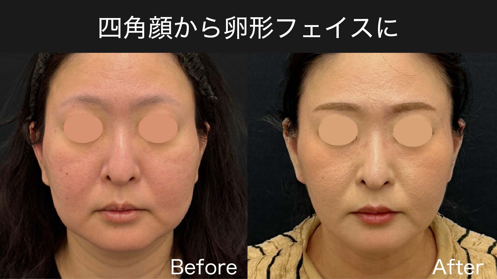 四角顔から卵形フェイスへ