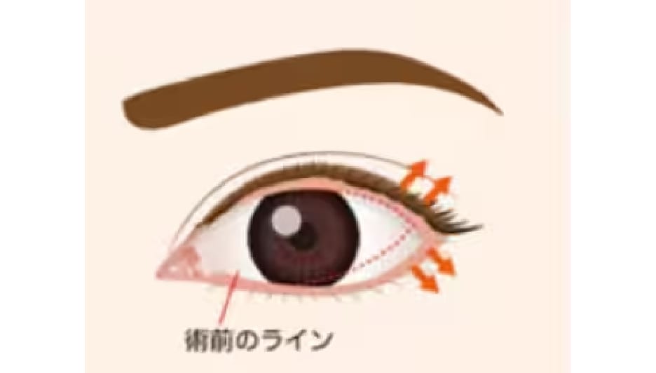 併用施術で美しいカーブの目元へ
