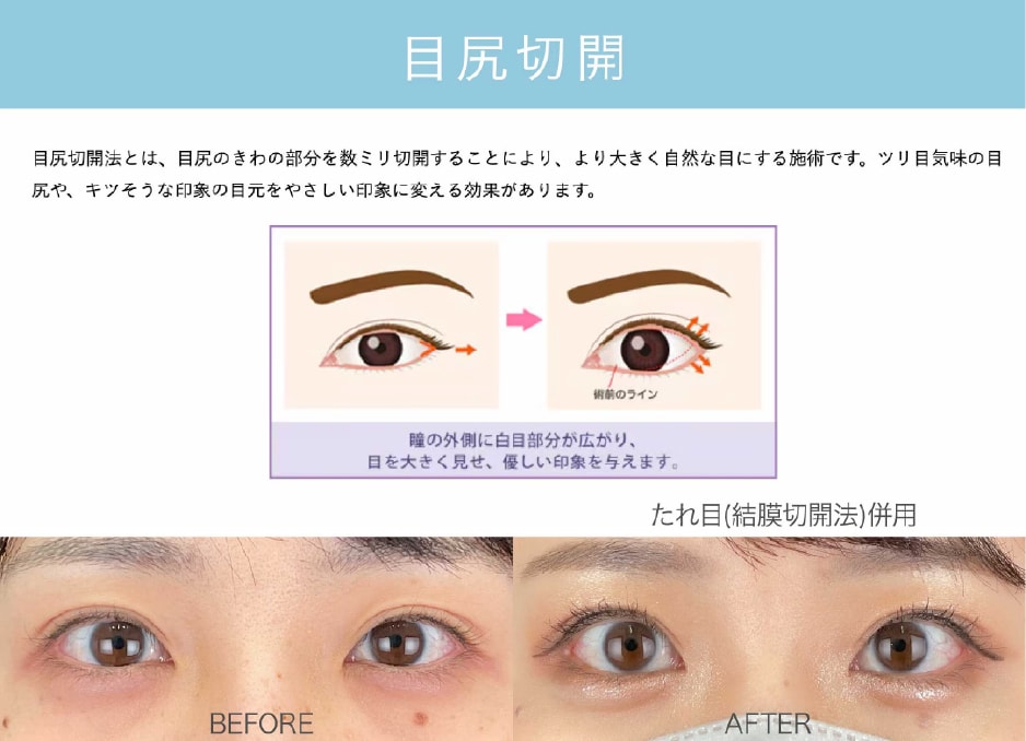 目尻切開法