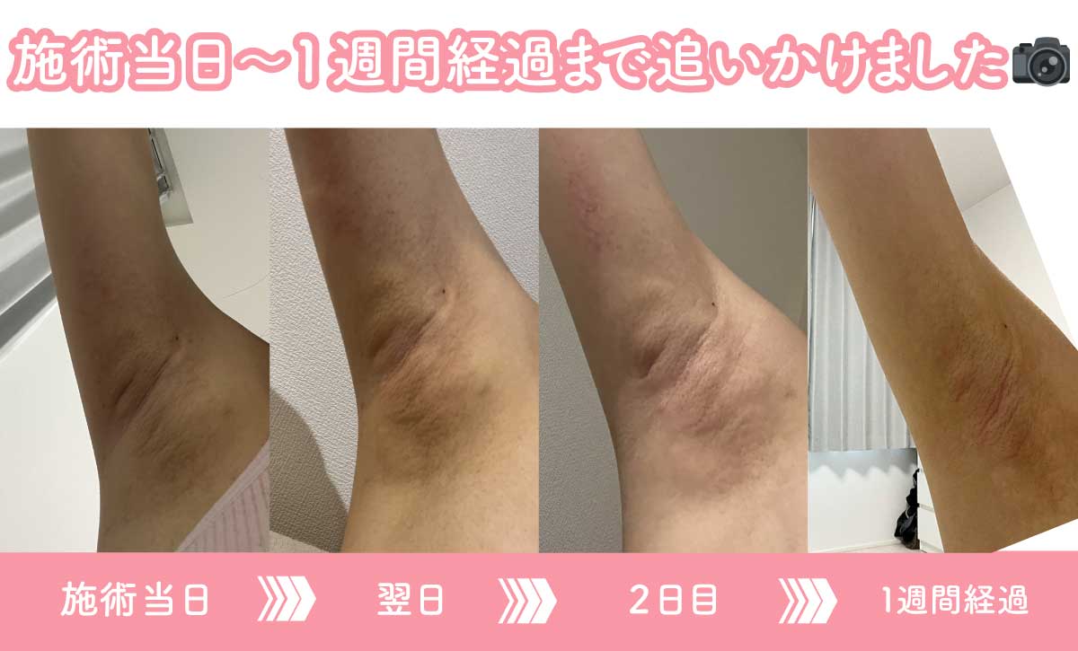 【リアル】ダウンタイム経過レポ
