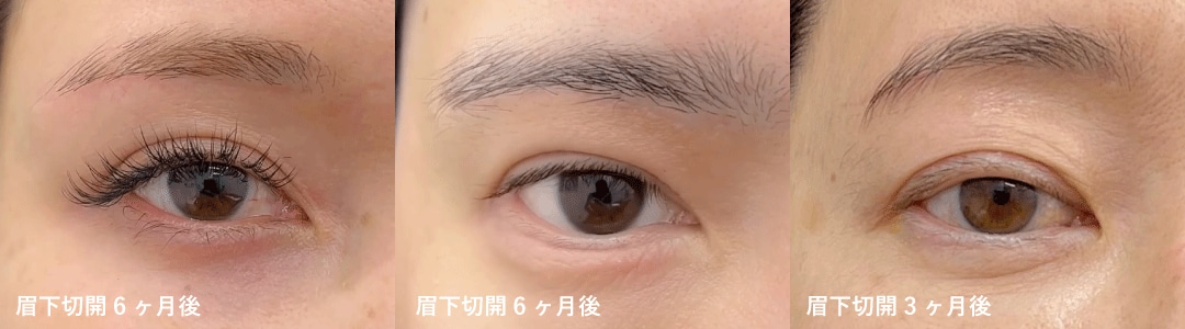 Q.眉下切開の傷跡は目立ちますか？