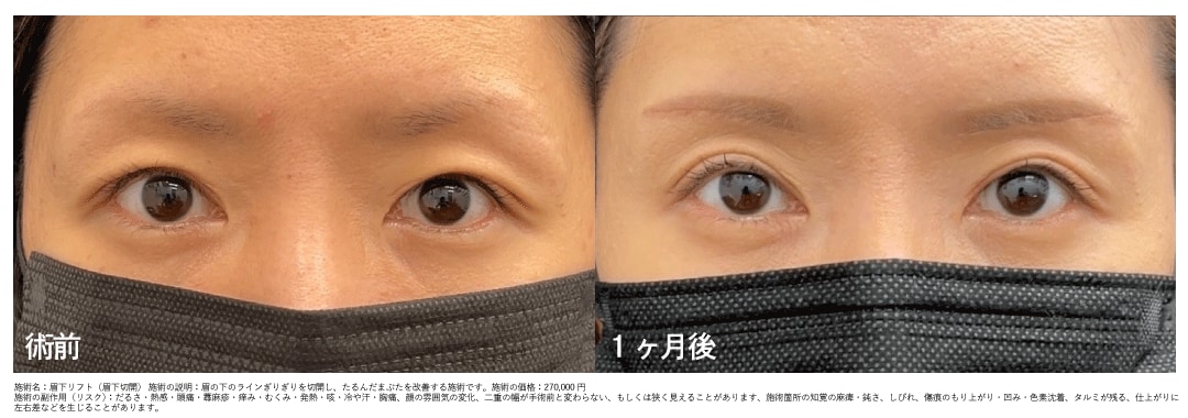 30代女性の＊眉下リフト+眼輪筋弁リフト+目の上リフト＊1ヶ月後