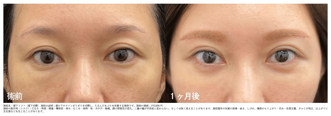 40代女性の＊眉下リフト+目の下の切らないたるみ取り＊1ヶ月後