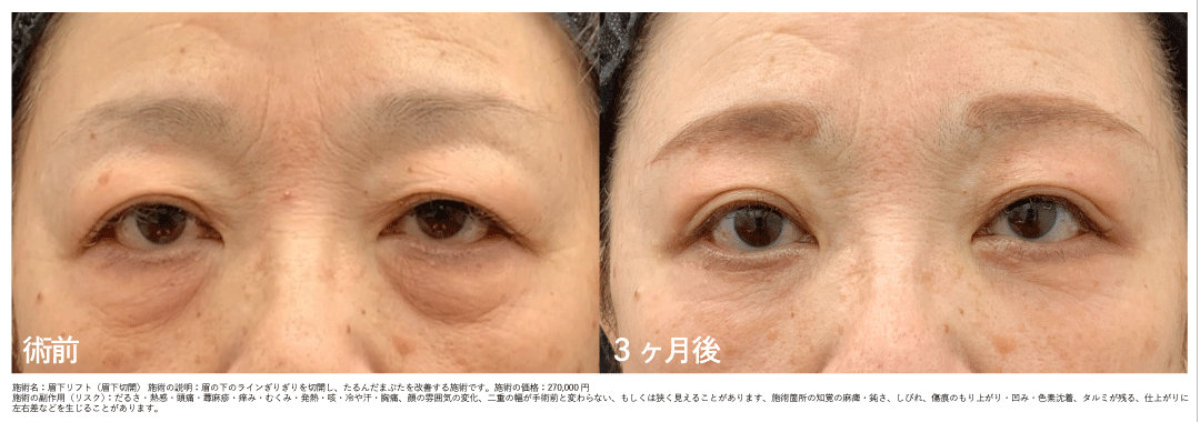 50代女性の＊眉下リフト+アイバックリムーブ+脂肪注入＊3ヶ月後
