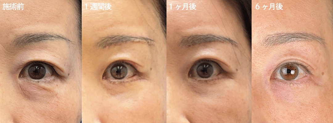 Q.眉下切開のダウンタイムについて知りたい