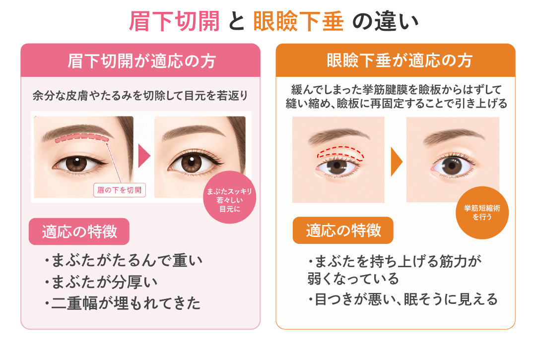 眉下切開と眼瞼下垂手術の違い
