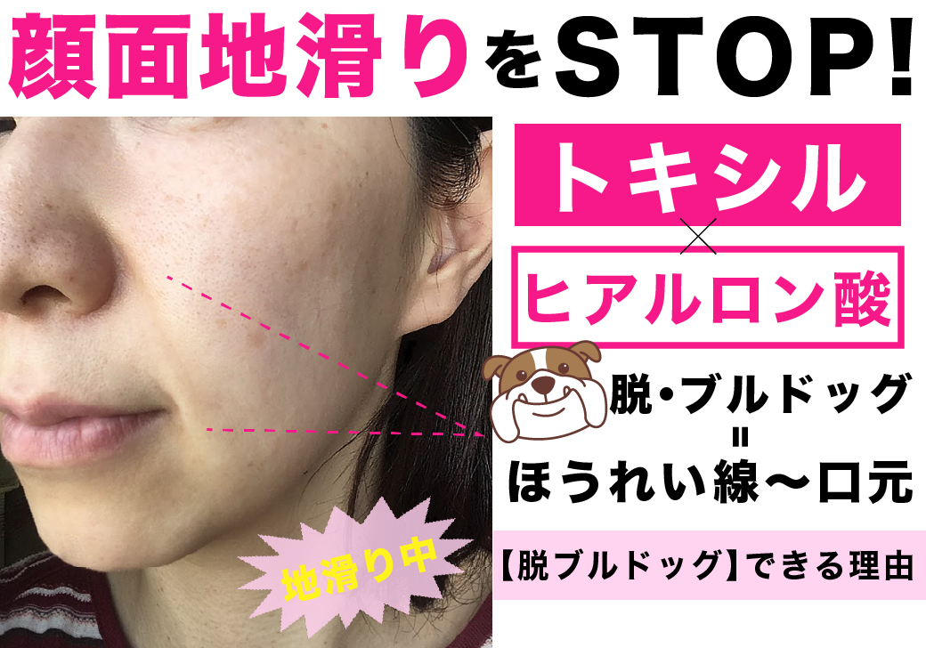 ほうれい線〜口元ケア次第でブルドッグ顔に！大阪堺東院の「美容針＆ヒアルロン酸」で正しいケアを！