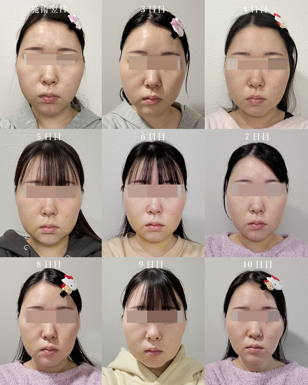 お顔の脂肪吸引ダウンタイム症例