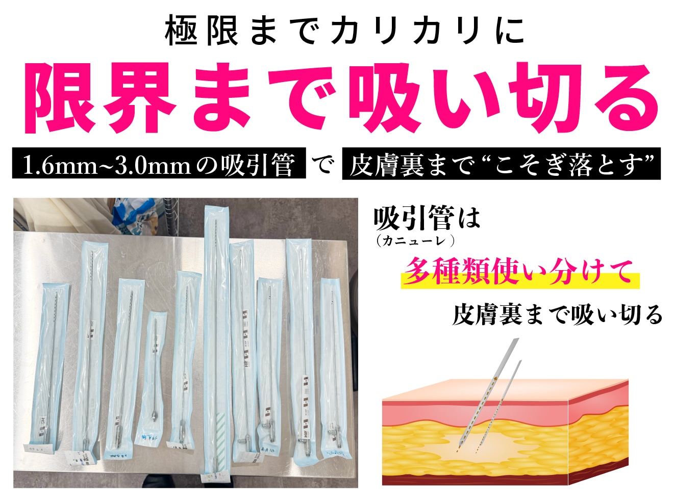 職人気質の丁寧な施術！極細管を使い分ける吸引技術