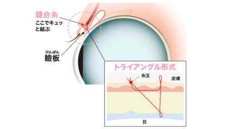 「週末二重®」「Teen二重®」の術式とメリット