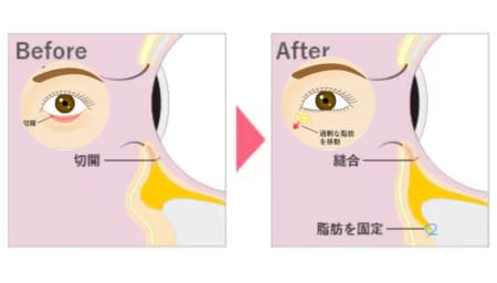 裏ハムラとは