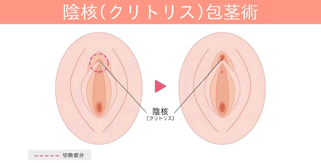 膣垢が貯まるのを防ぐためニオイ解消の効果があり、不感症改善にも！