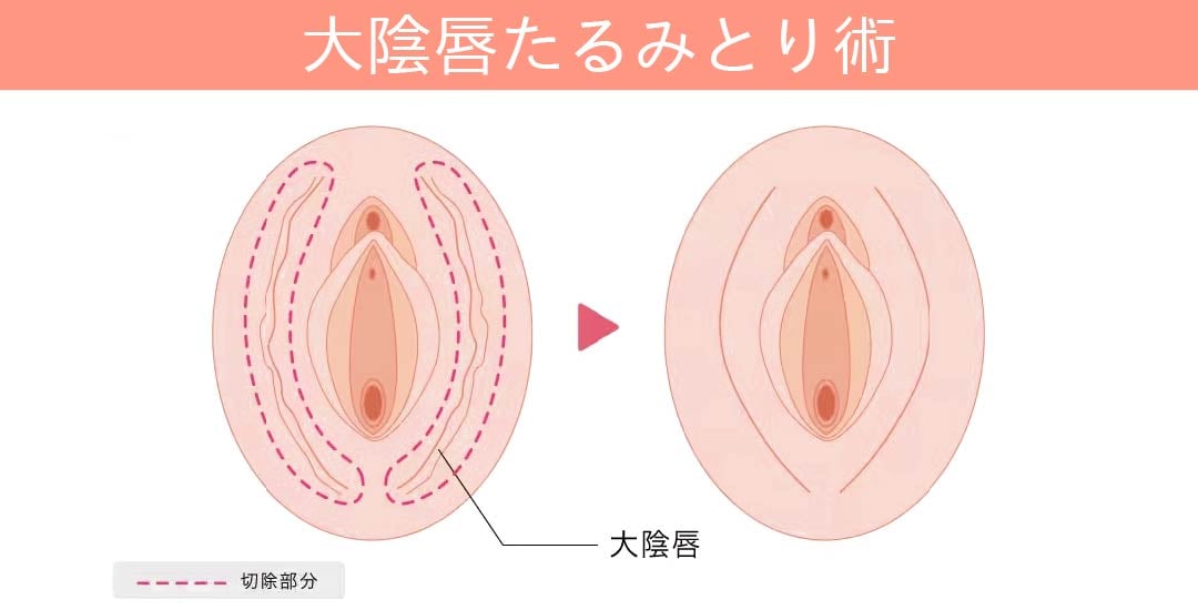 シワやたるみを除去！大陰唇のハリが戻って若々しい印象へ
